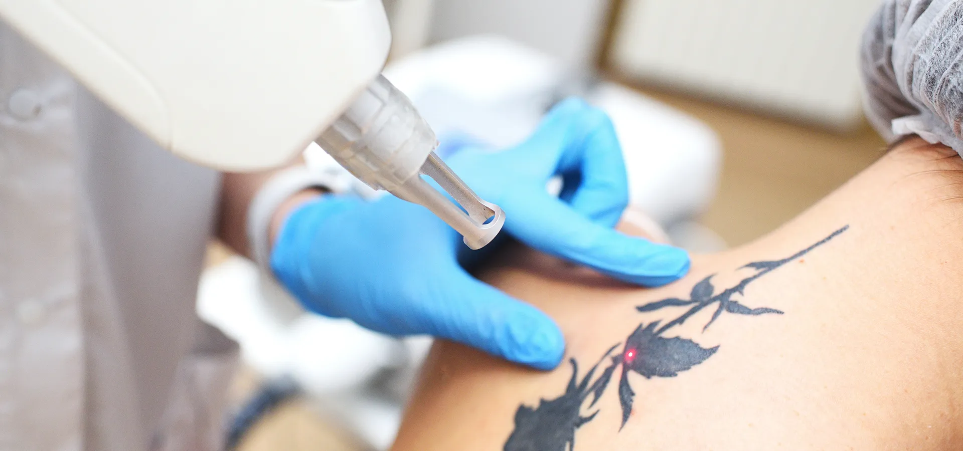 Détatouage au laser