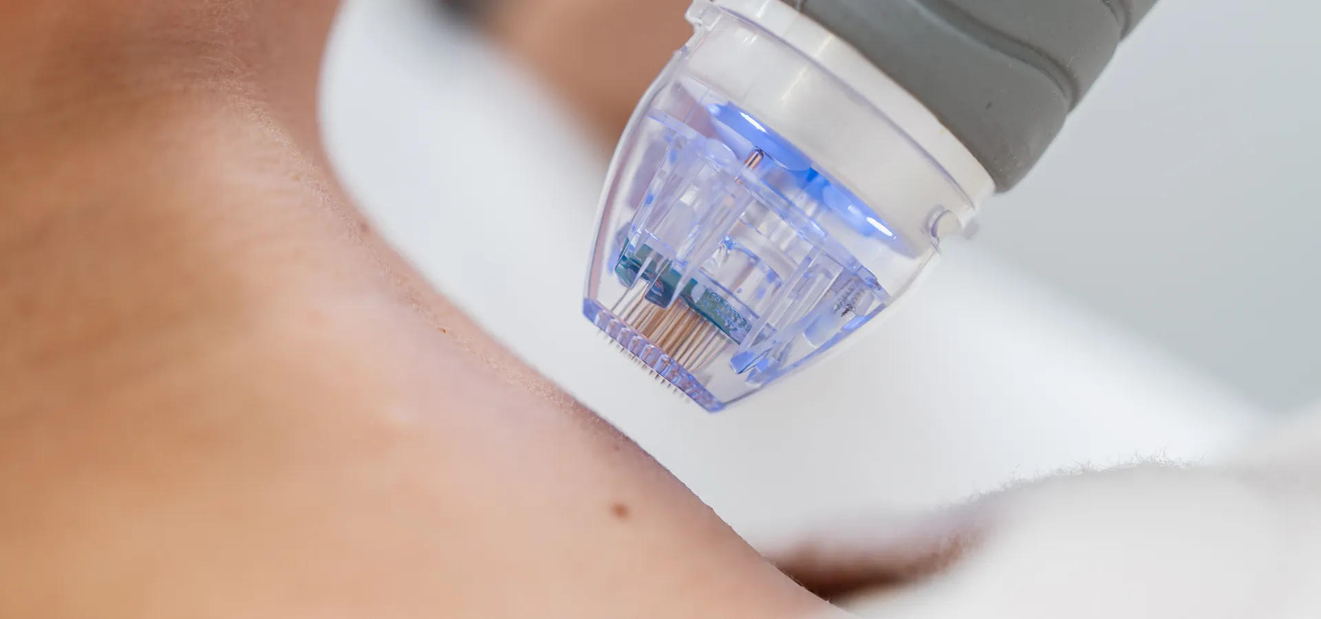 Personne recevant un traitement de microneedling sur le cou