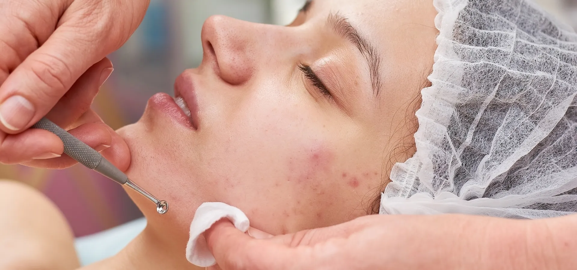 Femme recevant un traitement pour l'acné au laser