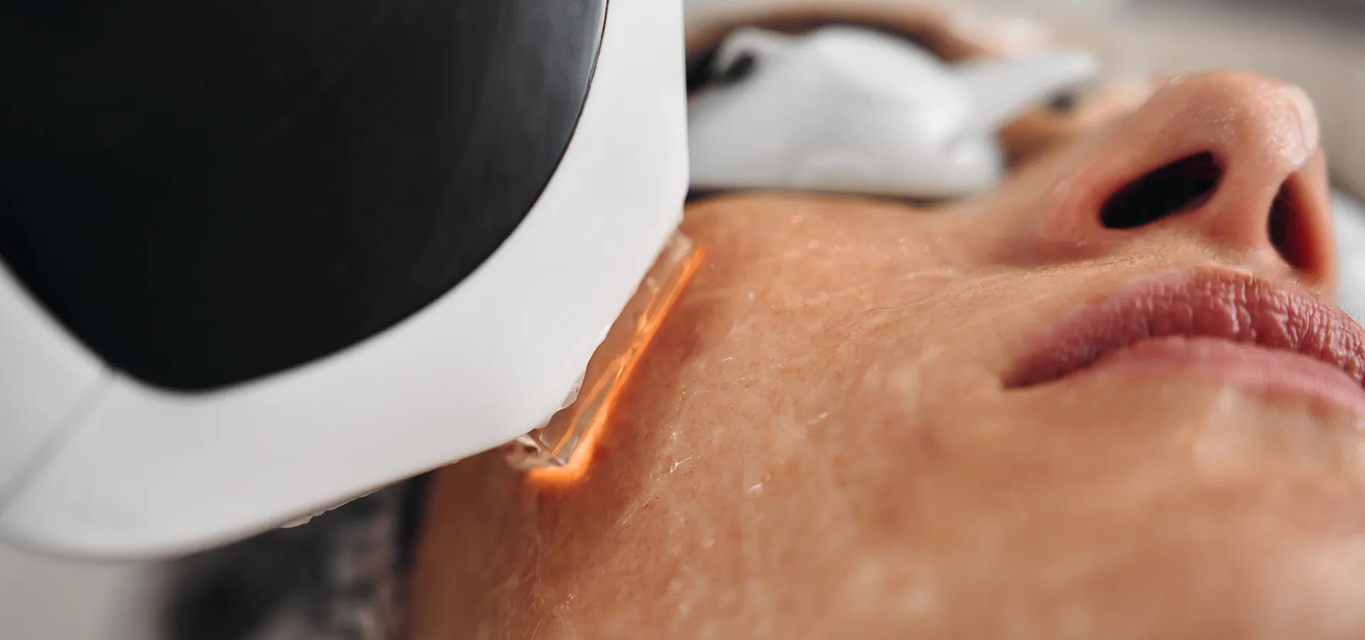 Femme recevant un traitement pour les cicatrices d'acné au laser