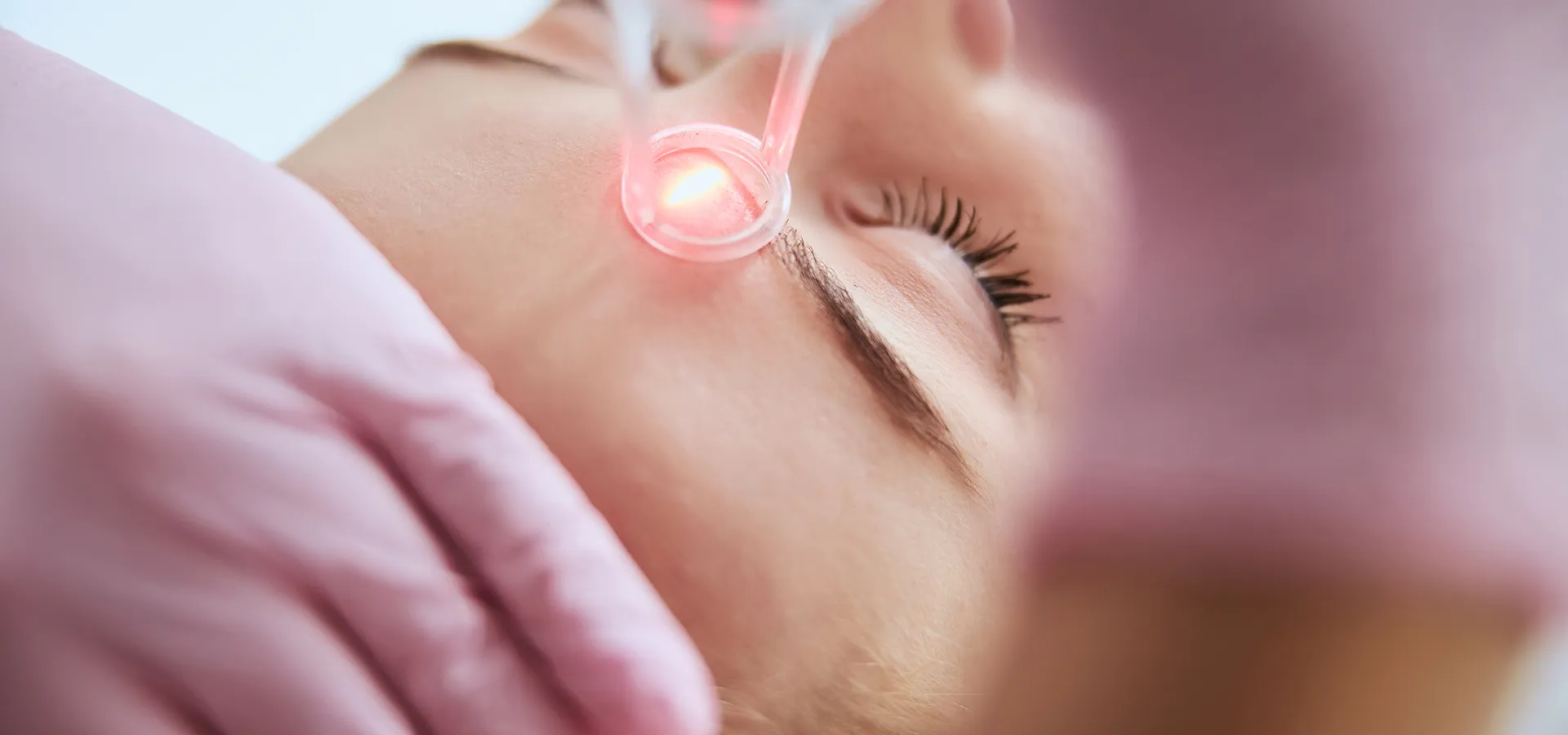 Traitement des rides au laser Fotona et Tixel